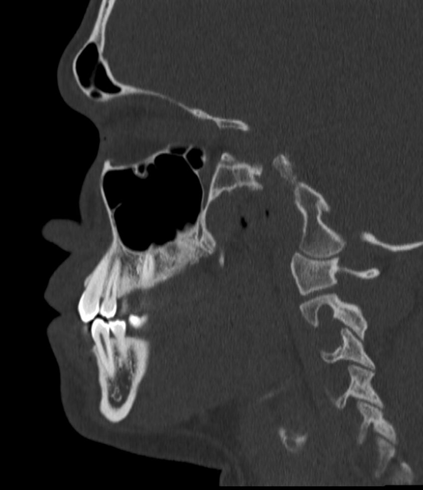 Normal facial bone CT (Radiopaedia 88742-105476 Sagittal bone window 70).jpg