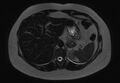 Normal liver MRI with Gadolinium (Radiopaedia 58913-66163 E 23).jpg