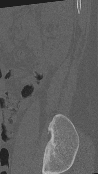 File:Normal lumbar spine CT (Radiopaedia 46533-50986 Sagittal bone window 7).png