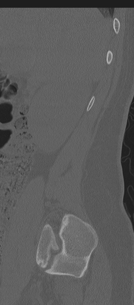 File:Normal lumbosacral CT (Radiopaedia 37923-39867 Sagittal bone window 88).png