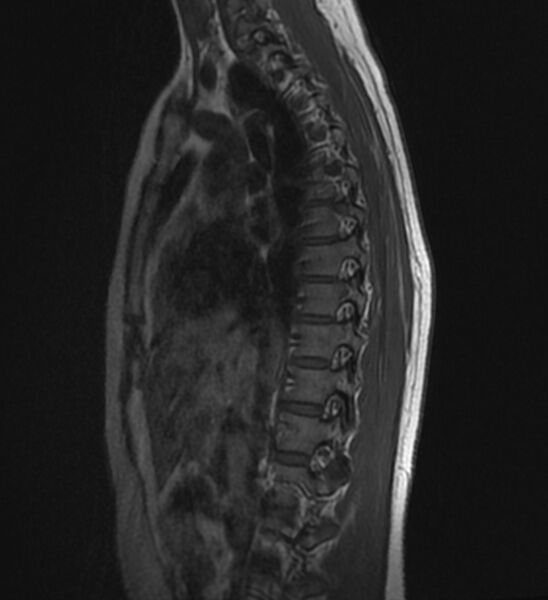 File:Normal thoracic spine MRI (Radiopaedia 41033-43781 Sagittal T1 4).jpg