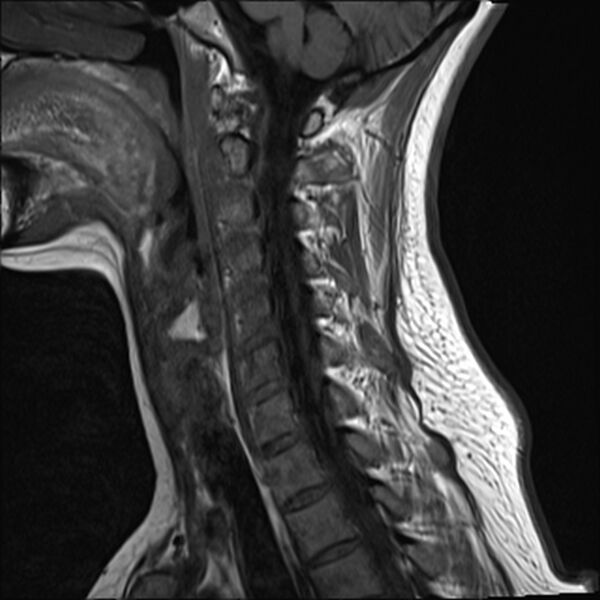 File:Normal trauma cervical spine MRI (Radiopaedia 32130-33071 Sagittal T1 10).jpg