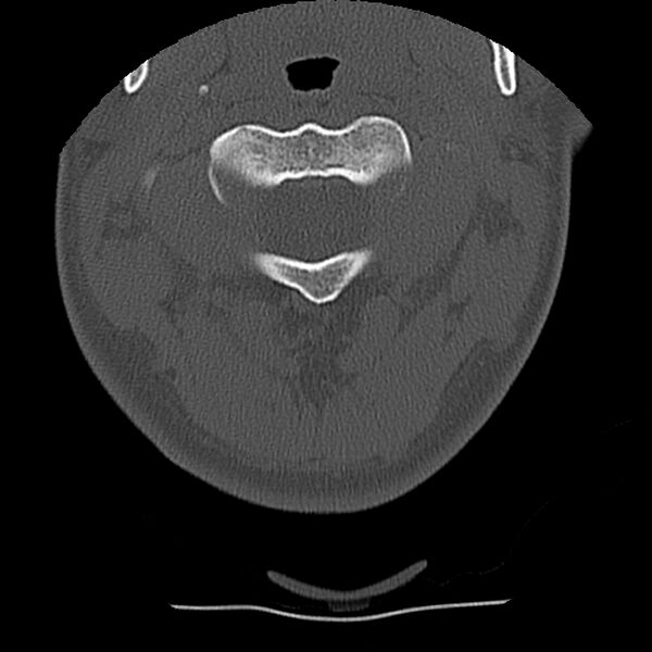 File:Normal trauma spine imaging (Radiopaedia 31753-32686 Axial bone window 15).jpg