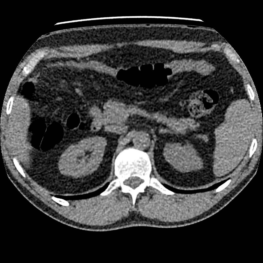 Obstructing ureteric calculus and ureteric anatomy (Radiopaedia 62730-71042 Axial non-contrast 18).jpg