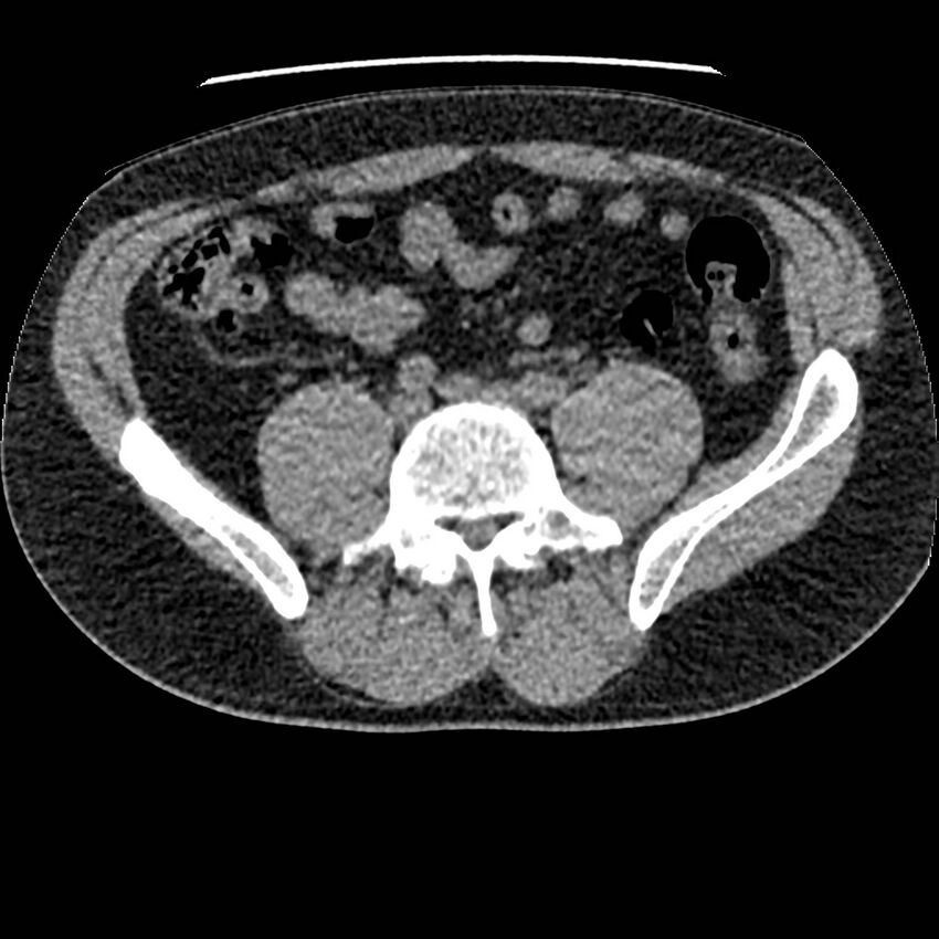 Obstructing ureteric calculus and ureteric anatomy (Radiopaedia 62730-71042 Axial non-contrast 98).jpg