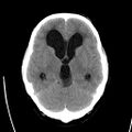 Obstructive hydrocephalus (Radiopaedia 30453-31119 Axial non-contrast 11).jpg