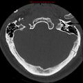 Occipital condyle fracture (Radiopaedia 18366-18208 Axial bone window 4).jpg