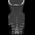 Occipital condyle fracture (Radiopaedia 31755-32691 Coronal bone window 32).jpg