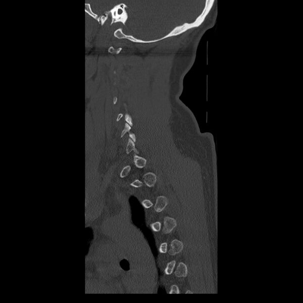 File:Occipital condyle fracture (Radiopaedia 31755-32691 Sagittal bone window 34).jpg