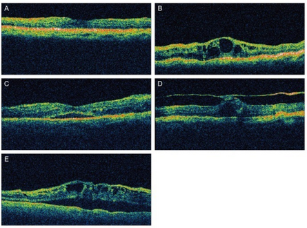 Different patterns of diabetic macular edema on optical coherence tomography a) Diffuse type of macular edema b) cystoid type of macular edema c) serous type of macular edema d) vitreomacular tractional type of macular edema e) mixed type of macular edema.