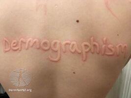 Dermographism