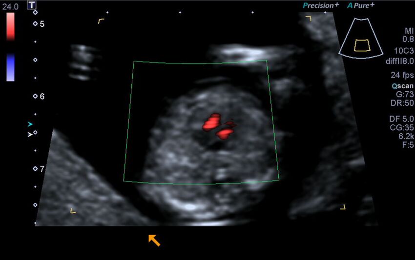 1st trimester nuchal-morphology ultrasound (Radiopaedia 44706-48477 Heart views cine with colour 112).jpg
