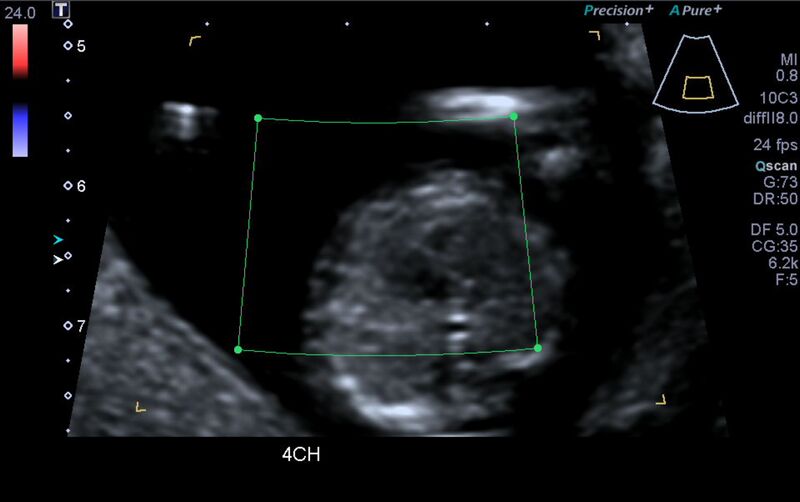 File:1st trimester nuchal-morphology ultrasound (Radiopaedia 44706-48477 Heart views cine with colour 14).jpg