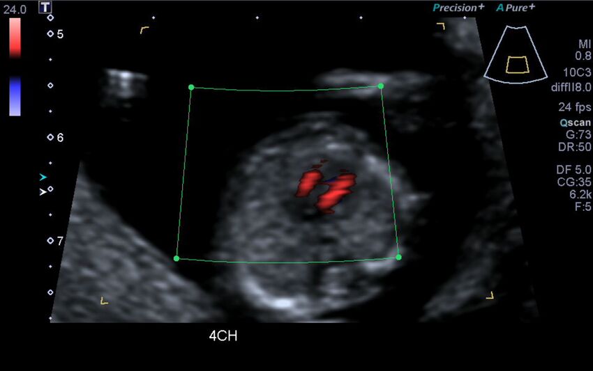 1st trimester nuchal-morphology ultrasound (Radiopaedia 44706-48477 Heart views cine with colour 71).jpg