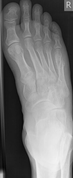 File:5th metatarsal fracture (Radiopaedia 6460-7813 Frontal 1).jpg