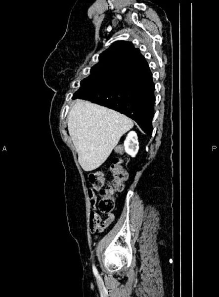 File:Abdominal aortic aneurysm (Radiopaedia 85063-100606 Sagittal C+ arterial phase 14).jpg