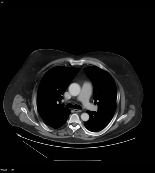 File:Abdominal aortic aneurysm with intramural hematoma then rupture (Radiopaedia 50278-55631 Axial C+ arterial phase 22).jpg