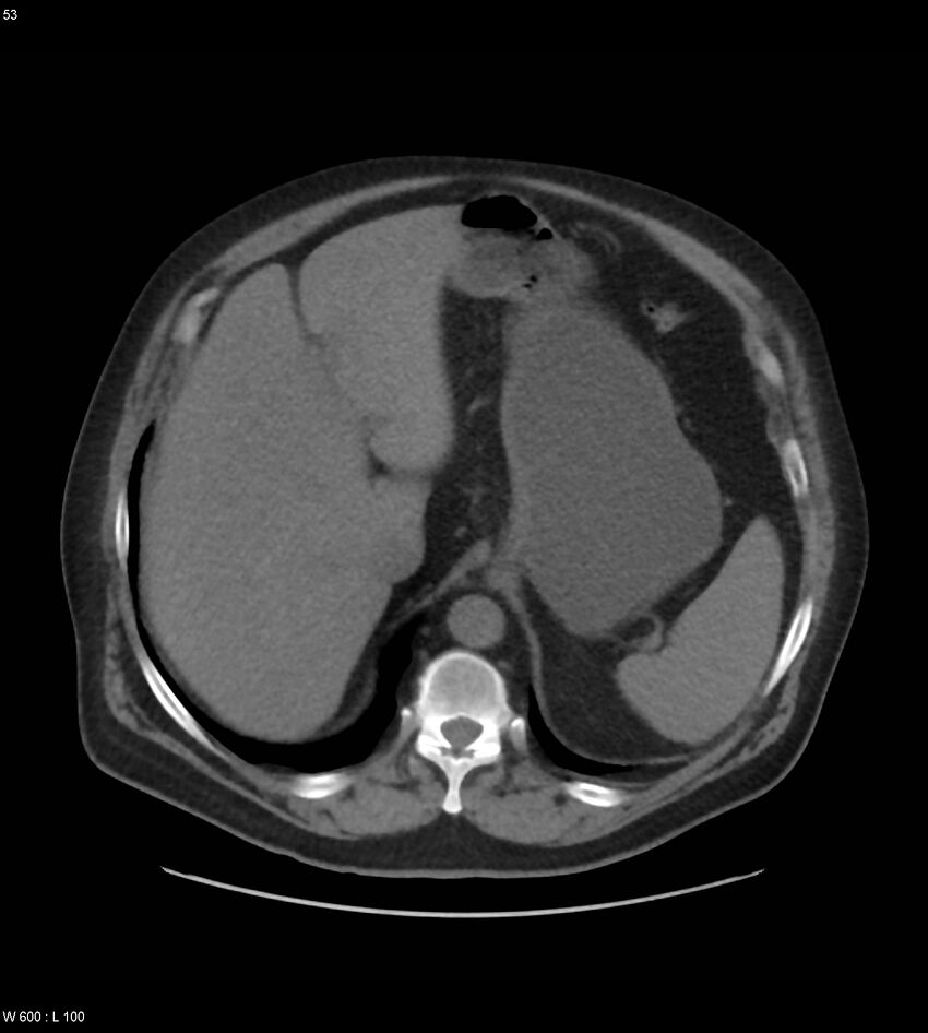 Abdominal aortic aneurysm with intramural hematoma then rupture (Radiopaedia 50278-55631 Axial non-contrast 49).jpg