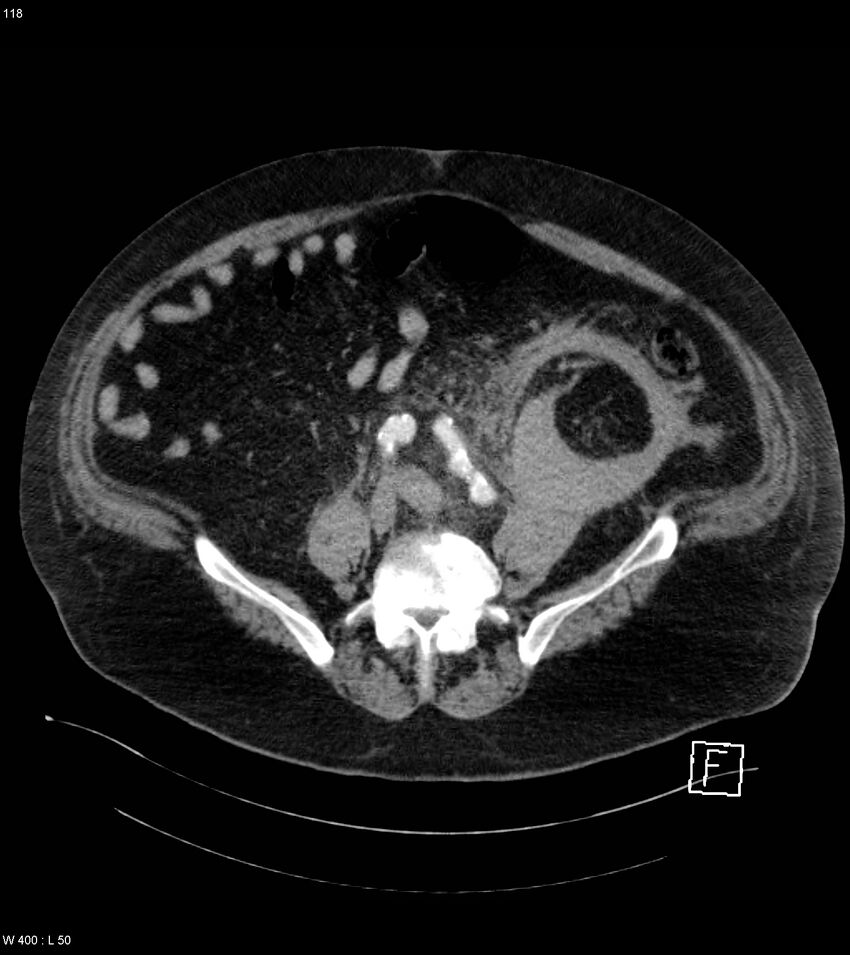 Abdominal aortic aneurysm with intramural hematoma then rupture (Radiopaedia 50278-55632 Axial C+ arterial phase 117).jpg