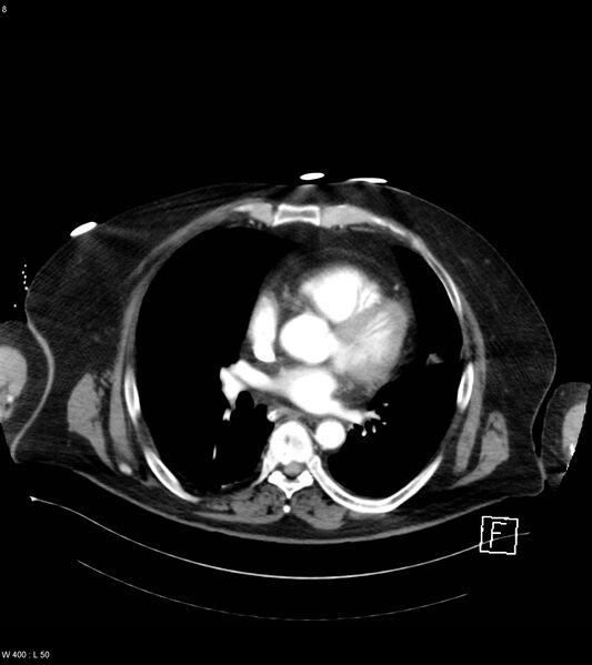 File:Abdominal aortic aneurysm with intramural hematoma then rupture (Radiopaedia 50278-55632 Axial C+ arterial phase 7).jpg