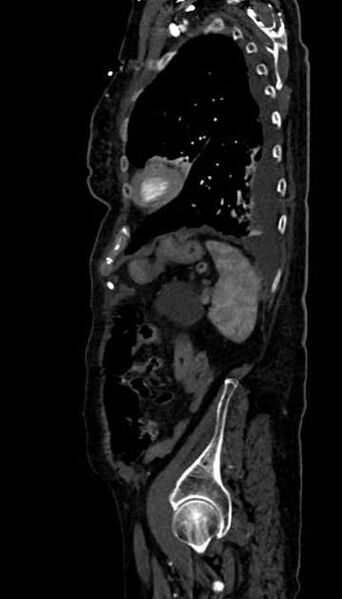 File:Abdominal aortic aneurysm with thrombus fissuration (Radiopaedia 73192-83919 Sagittal C+ arterial phase 22).jpg