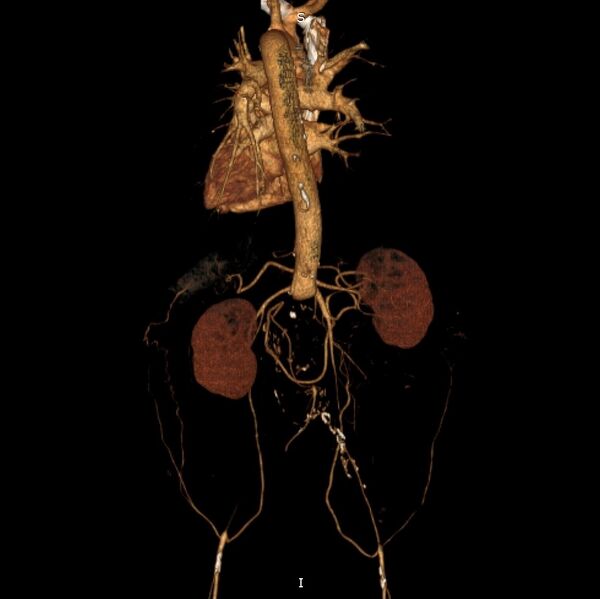 File:Abdominal aortic interposition tube graft and aneurysm thrombosis (Radiopaedia 71438-81857 3D VRT C+ arterial phase 9).jpg
