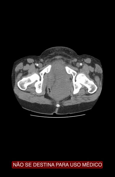 File:Abdominal desmoid tumor (Radiopaedia 44024-47540 Axial C+ arterial phase 54).jpg