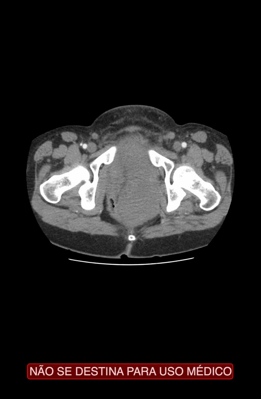 Abdominal desmoid tumor (Radiopaedia 44024-47540 Axial C+ arterial phase 54).jpg