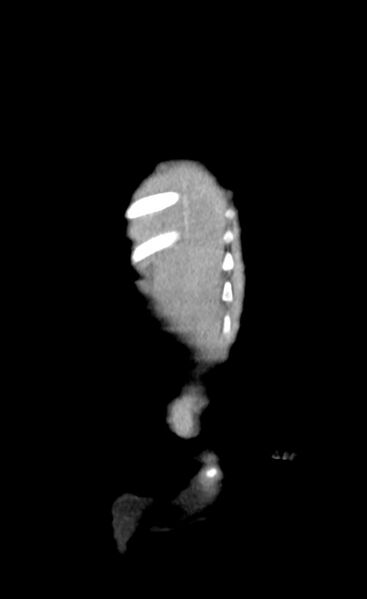 File:Abdominopelvic rhabdomyosarcoma (Radiopaedia 78356-90984 Coronal C+ portal venous phase 85).jpg
