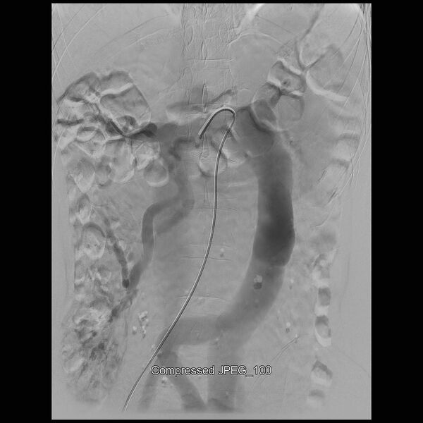 File:Abernethy malformation (Radiopaedia 42006-45462 Frontal Superior mesenteric artery 17).jpg