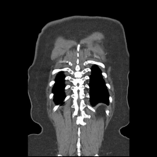 File:Aberrant right subclavian and left vertebral arteries (Radiopaedia 43467-46847 Coronal C+ portal venous phase 79).jpg