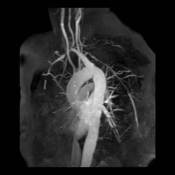 File:Aberrant right subclavian artery with background Takayasu arteritis (Radiopaedia 21423-21363 MRA 2).jpg