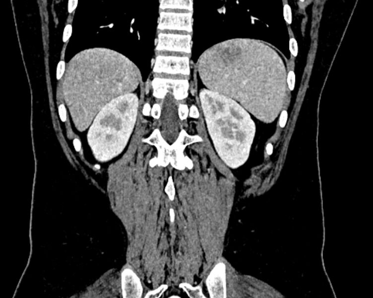 File:Accessory right inferior hepatic vein (Radiopaedia 75207-86305 Coronal C+ portal venous phase 64).jpg