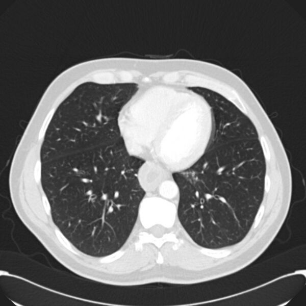 File:Achalasia (Radiopaedia 24937-25206 Axial lung window 24).jpg