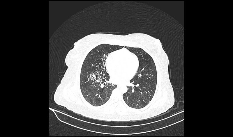 File:Acquired tracheo-esophageal fistula (Radiopaedia 51356-57103 Axial lung window 25).jpg