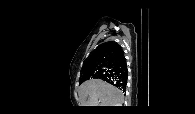 File:Acquired tracheo-esophageal fistula (Radiopaedia 51356-57103 Sagittal C+ arterial phase 14).jpg