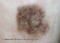 Acral lentiginous melanoma 4 macro (DermNet NZ alm-4-macro).jpg