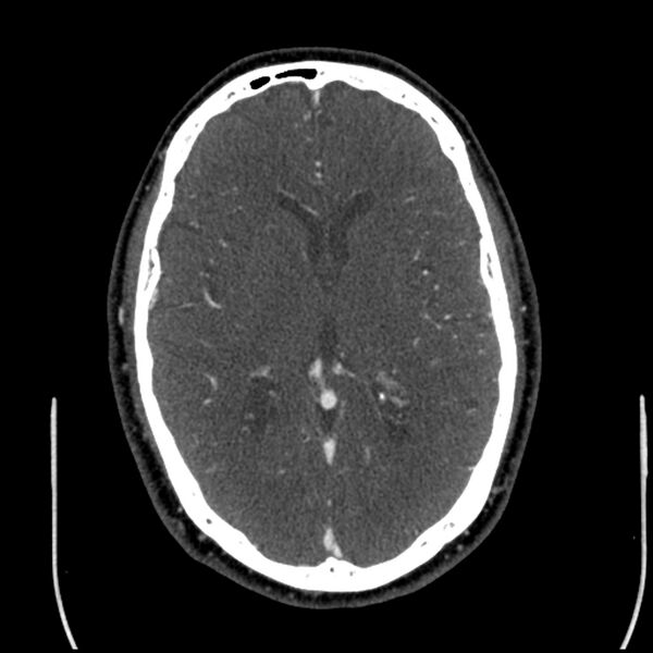 File:Acute A3 occlusion with ACA ischemic penumbra (CT perfusion) (Radiopaedia 72036-82527 Axial C+ arterial phase thins 66).jpg