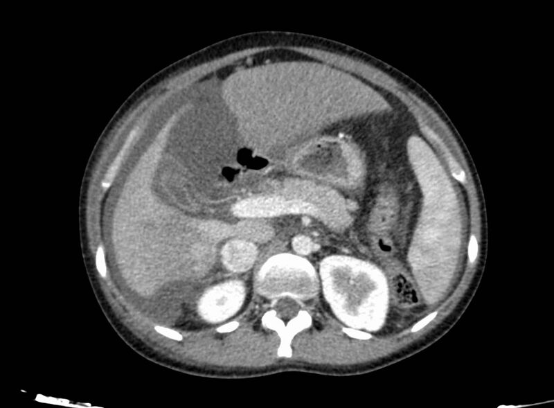 File:Acute Budd-Chiari syndrome (Radiopaedia 60858-68638 Axial C+ portal venous phase 107).jpg
