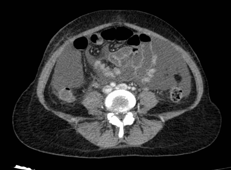 File:Acute Budd-Chiari syndrome (Radiopaedia 60858-68638 Axial C+ portal venous phase 196).jpg