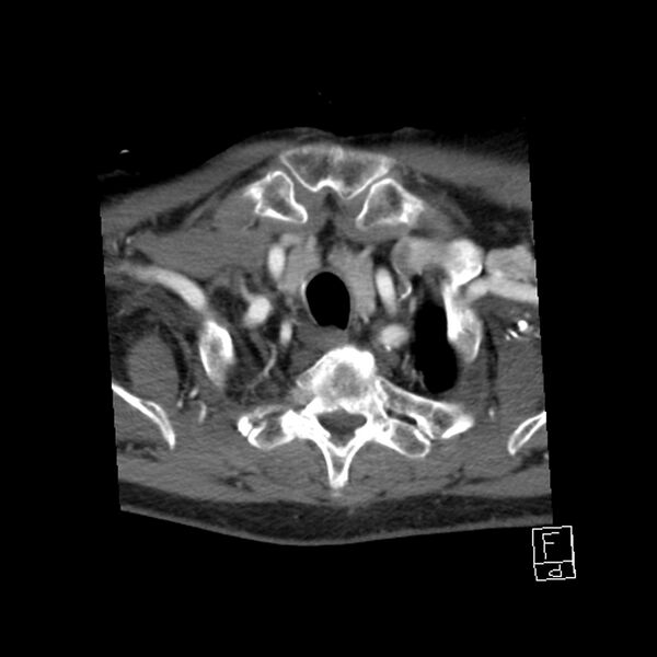 File:Acute ICA ischemic penumbra due to high-grade CCA stenosis (CT perfusion) (Radiopaedia 72038-82530 Axial C+ arterial phase 69).jpg