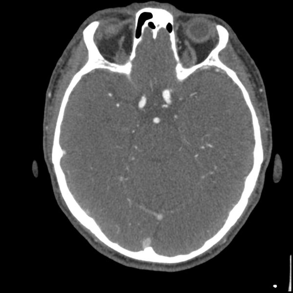 File:Acute P1 occlusion with PCA ischemia penumbra (CT perfusion) (Radiopaedia 72084-82587 Axial C+ arterial thins 51).jpg