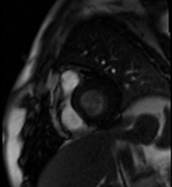 File:Acute anteroseptal myocardial infarction (Radiopaedia 68409-77945 Short axis (basal) Perfusion 7).jpg