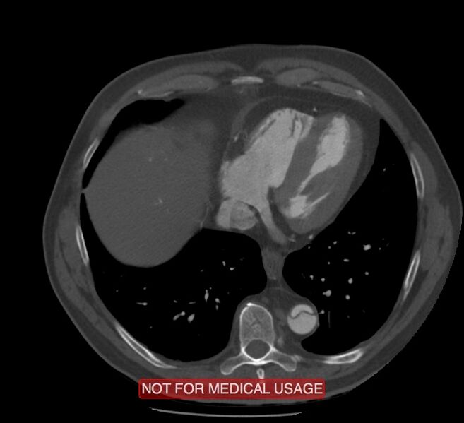 File:Acute aortic dissection - Stanford type A (Radiopaedia 40661-43285 Axial C+ arterial phase 54).jpg