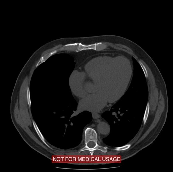 File:Acute aortic dissection - Stanford type A (Radiopaedia 40661-43285 Axial non-contrast 41).jpg