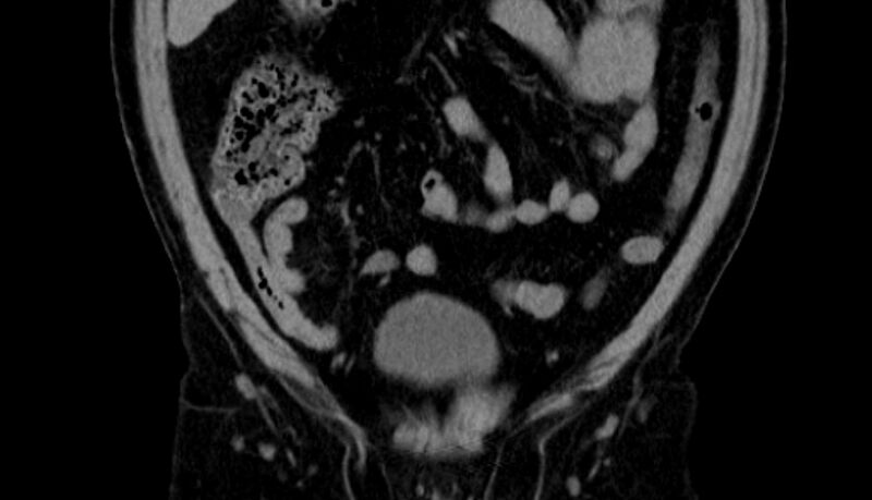 File:Acute appendicitis (Radiopaedia 13030-13091 Coronal non-contrast 3).jpg