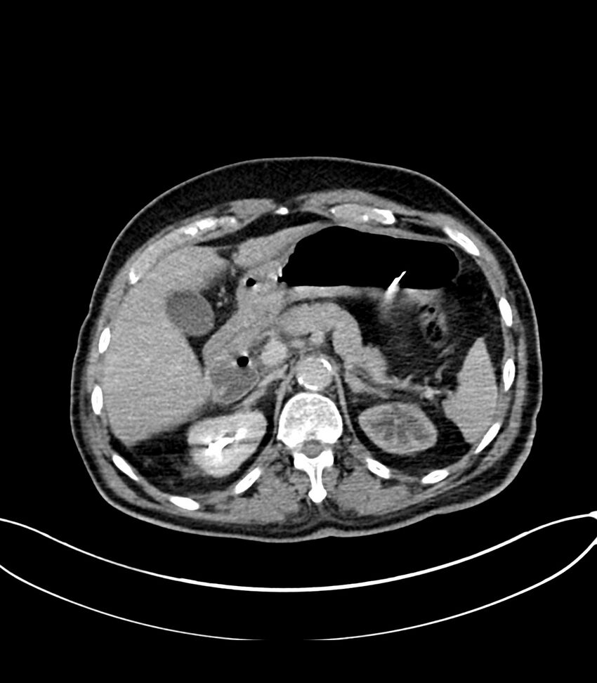 Acute arterial mesenteric ischemia (Radiopaedia 78238-90828 Axial C+ delayed 42).jpg