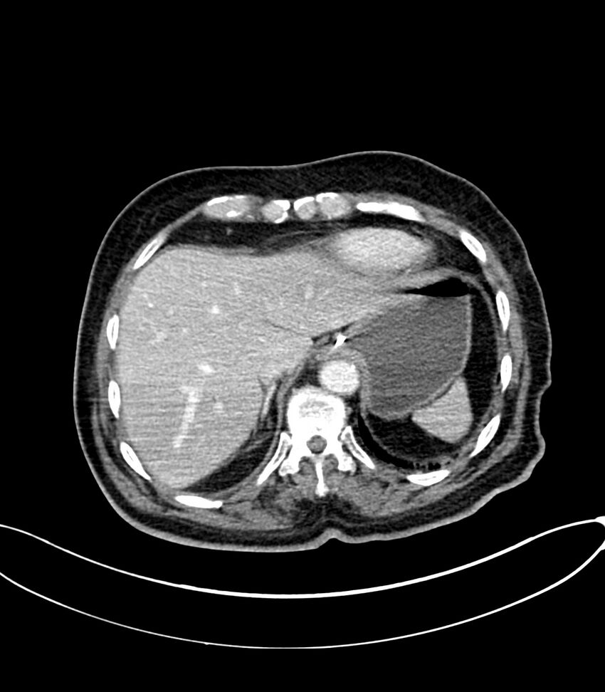 Acute arterial mesenteric ischemia (Radiopaedia 78238-90828 Axial C+ portal venous phase 26).jpg