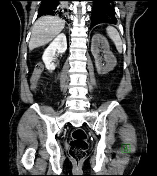 File:Acute arterial mesenteric ischemia (Radiopaedia 78238-90828 Coronal C+ portal venous phase 66).jpg