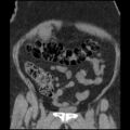 Acute cholecystitis and ureteric colic (Radiopaedia 42330-45444 Coronal prone 29).jpg